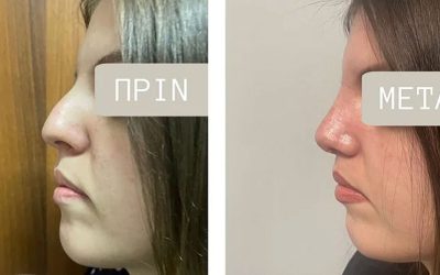 Αισθητική και Λειτουργική Ρινοπλαστική